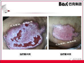 一切皮肤病及外伤的克星,传统文化义工的事业 巴克产品介绍