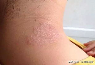 患了牛皮癣 吃这个食品,对牛皮癣的康复很有帮助