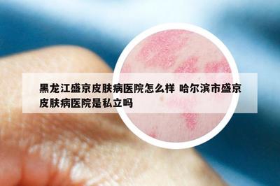 黑龙江盛京皮肤病医院怎么样 哈尔滨市盛京皮肤病医院是私立吗