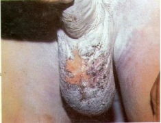 男性阴囊湿疹是由于不注意卫生导致的吗