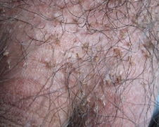 青岛皮肤病研究院专家介绍患上虱病该怎么治疗