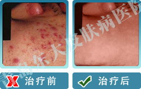 山东治疗毛囊炎较好的医院