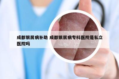 成都银屑病补助 成都银屑病专科医院是私立医院吗