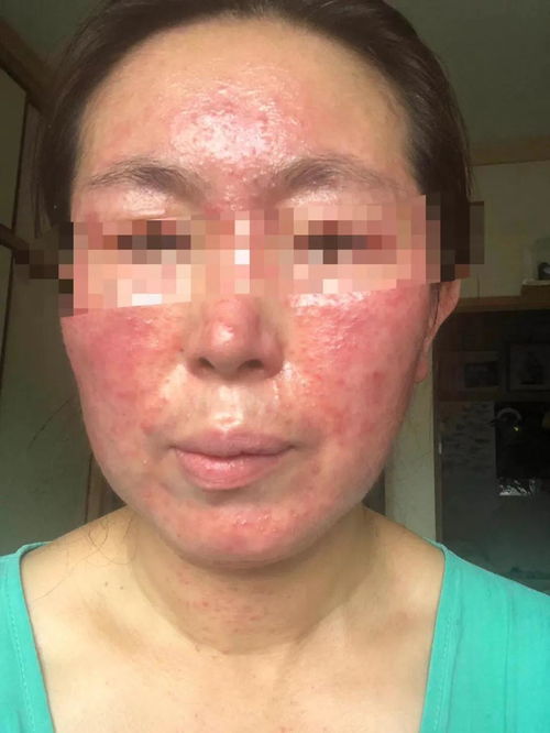 广州中医名医皮肤病研究院 激素依赖性皮炎,除了停用激素,还要怎么办