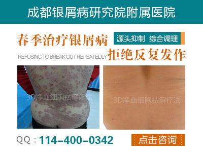 彭州市人民医院银屑病专科_健康频道