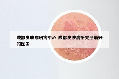 成都皮肤病研究中心 成都皮肤病研究所最好的医生