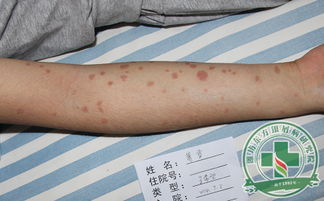潍坊东方银屑病研究院分享如何治疗银屑病有效果