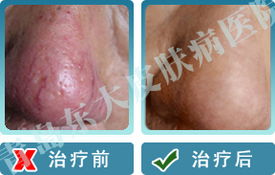 酒槽鼻患者秋季应该怎么护理