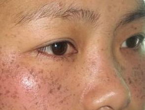 去黄褐斑多年未果,尝尽各种办法都无效,其实去它就应该用专业祛斑产品