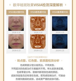 美颜套餐 eleen清斑套餐光子嫩肤 激光祛斑 美白 点击查看 美妆博主专业祛斑方案 悦美整形