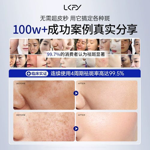 什么牌子淡斑效果最好最安全 专业淡斑体验分享