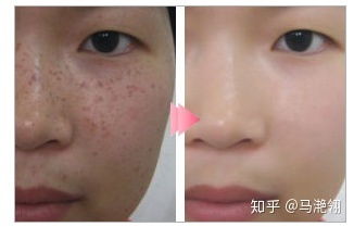 皮秒激光的原理是什么,有哪些注意事项